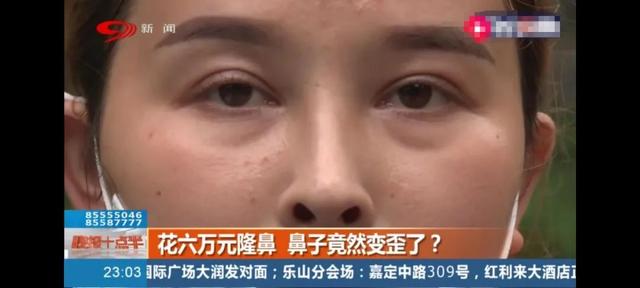 成都四女子隆鼻后成了“鼻歪歪”……